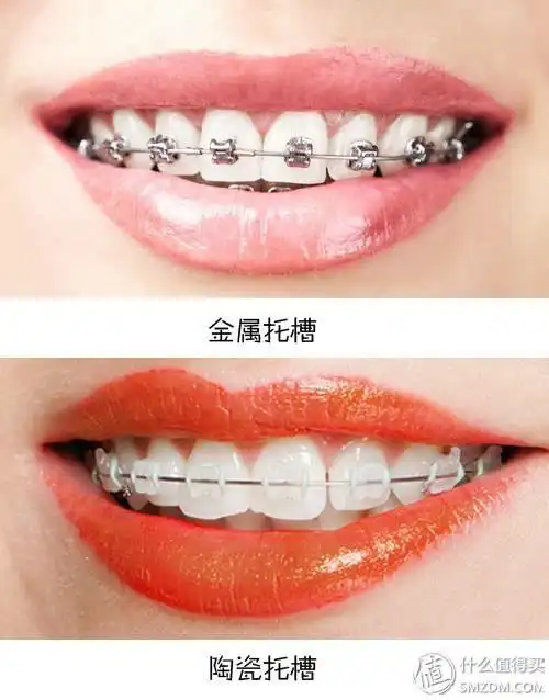 牙齿矫正,让孩子的笑容自信而美丽