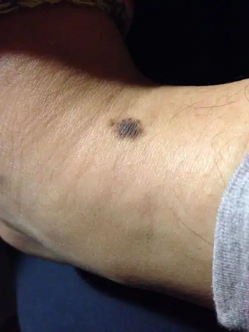 从出生我脚踝上有个黑痣,随着长大一直都在,样子和身上其他地方长的痣