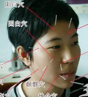 针灸治疗面瘫的内容简介