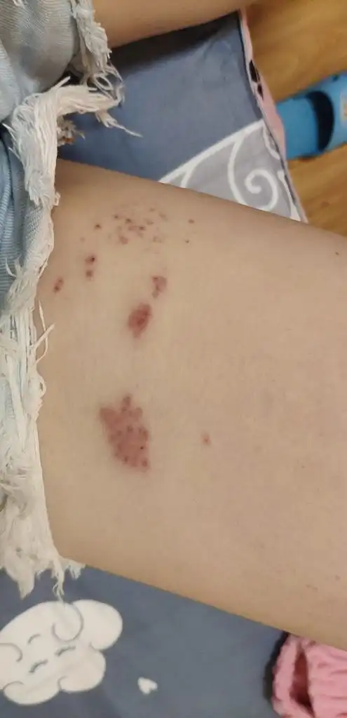 腿上突然长了好多小疙瘩 越长越多了 去诊所开过药摸的 后来越来越