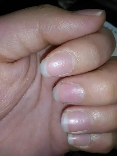 有谁知道这指甲为什么会长成这样吗 之前只有中指有 现在越来越多了