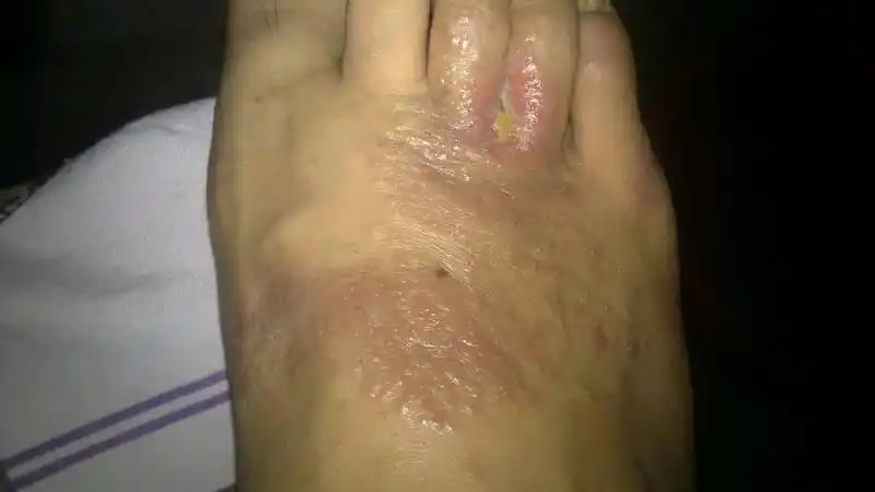 关于这种情况,考虑是足癣的可能性较大,也就是所谓的脚气,是真菌感染