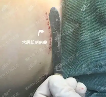 术后即刻的疤痕效果图