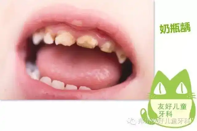 很多的家长在 郑州友好牙科咨询儿牙专家:乳牙龋坏形成的原因 ---不