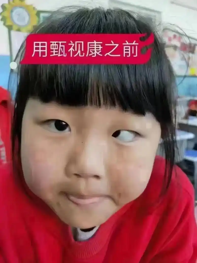 [福]斜视 弱视 来个牛逼案例反馈,看看图片! 虽然这是个案 - 抖音