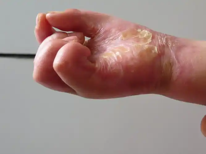 问题:严主任,我女儿4月份烧的手,现在弯曲畸形