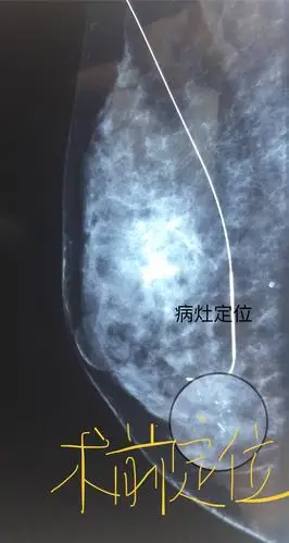 余"查体:双乳对称,半球形,乳头位于同一平面,皮肤无破溃,酒窝征等改变