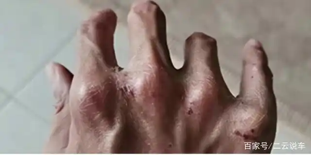 谢霆锋的手血迹干枯,赵丽颖的后脑血栓,没想到这些明星还有这些不为人