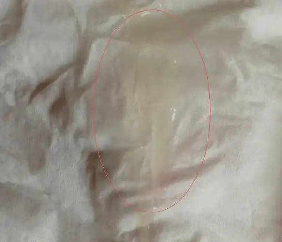 3,肿胀充血分泌物带有臭味,形状如米糠,也呈黄或黄绿色.