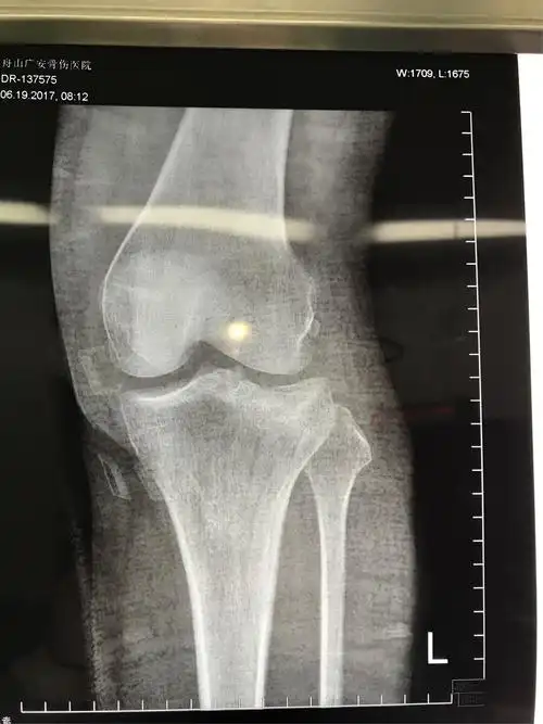 腓骨头上入路治疗后外侧胫骨平台骨折