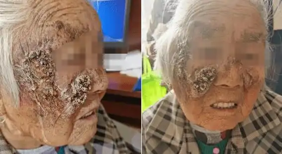 【病例夹】"老年斑"竟然长成了皮肤癌_老太_治疗_肿瘤