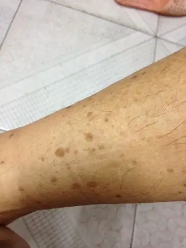 各位大神看看脚上黑斑是什么症状,看有什么良药,谢谢啦