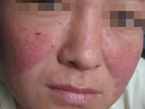 系统性红斑狼疮