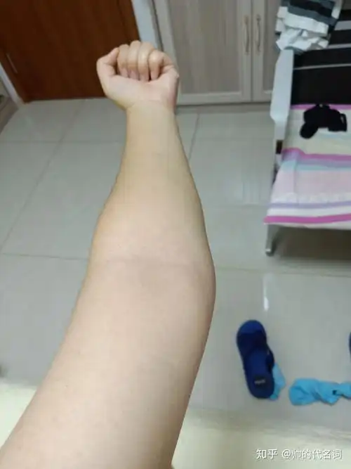 肘外翻 女兵 - 知乎