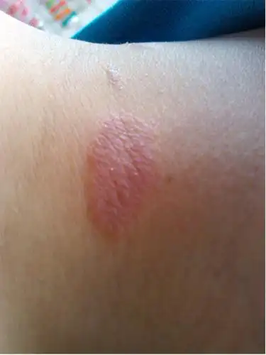 脖子后面长藓怎么办?