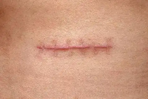 另外,在生活中应避免动伤口,医生建议患者可在伤口处贴硅胶贴片,绑