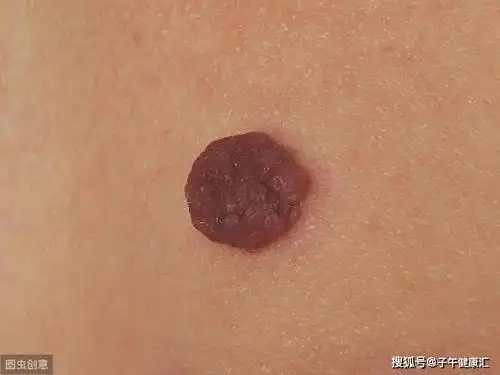 29岁辣妈长"疙瘩",越抠越多!医生:有"菜花"就是感染hpv了