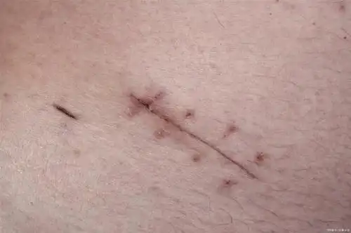 心脏做完手术伤口是如何缝合的,会渗血吗?术后该如何护理?