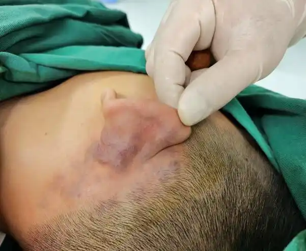 静脉壁血管平滑肌细胞稀疏,排列不规则,是一种低流速的脉管畸形