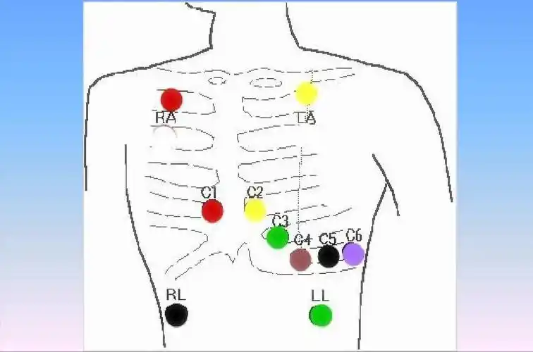 动态心电图的临床应用
