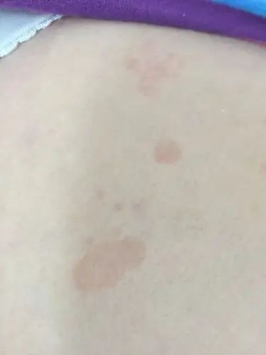 背上长了红色斑块,不疼不痒的?