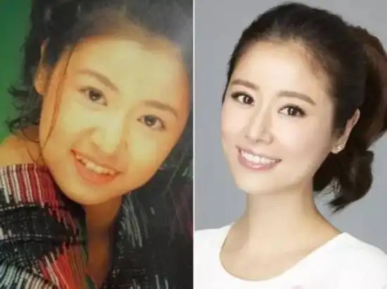 我们的大白杨,矫正前一口"魔鬼牙",矫正后整齐美丽的大白牙,立马升级