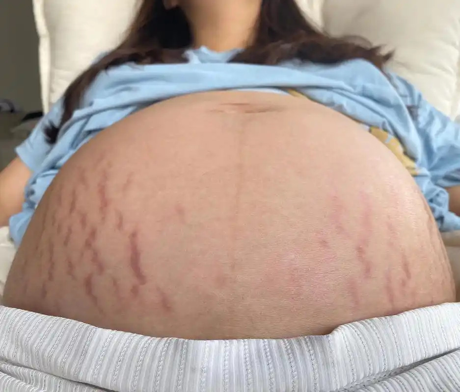 我感觉我真的快挺不住了,怀孕7个月,肚子上突然涨了那么多妊娠 - 抖音