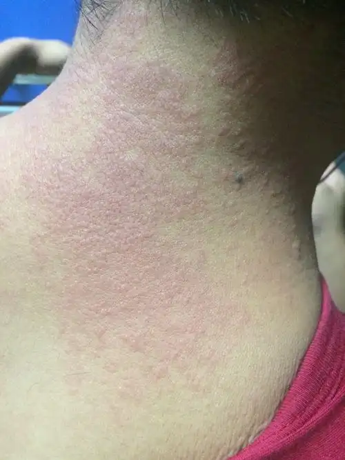 问:我老公最近脖子越长越多这些是什么?极痒范围越来越大,怎么回事?