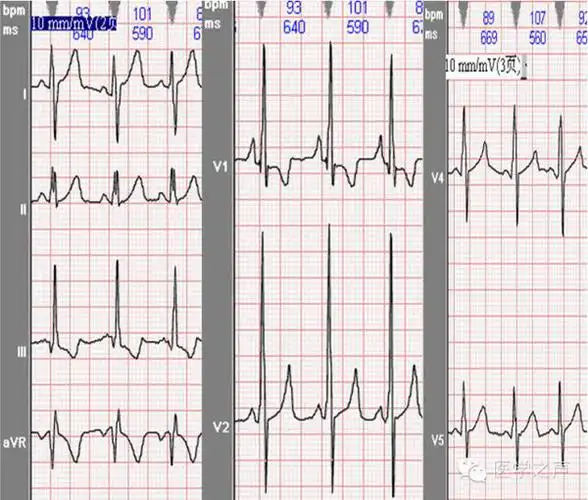 心电图课堂第5期右室肥大与双侧心室肥厚