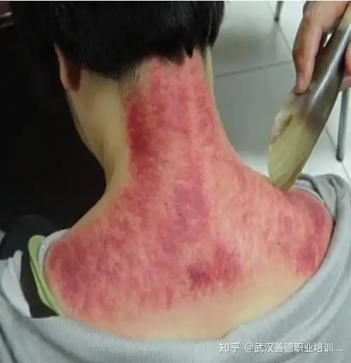 浅谈中医那些事刮痧