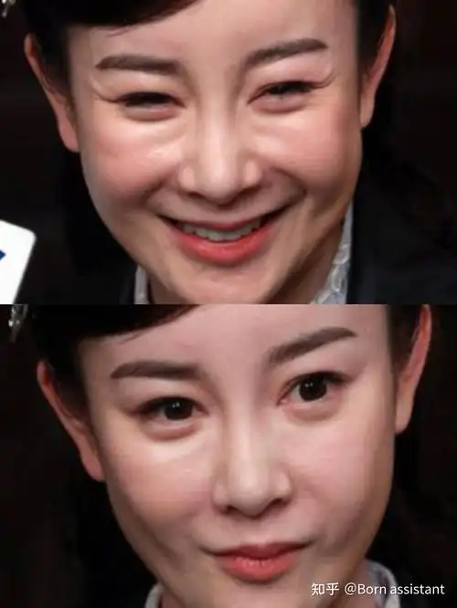 明星都逃不过的印第安纹是什么原因形成的 - 知乎