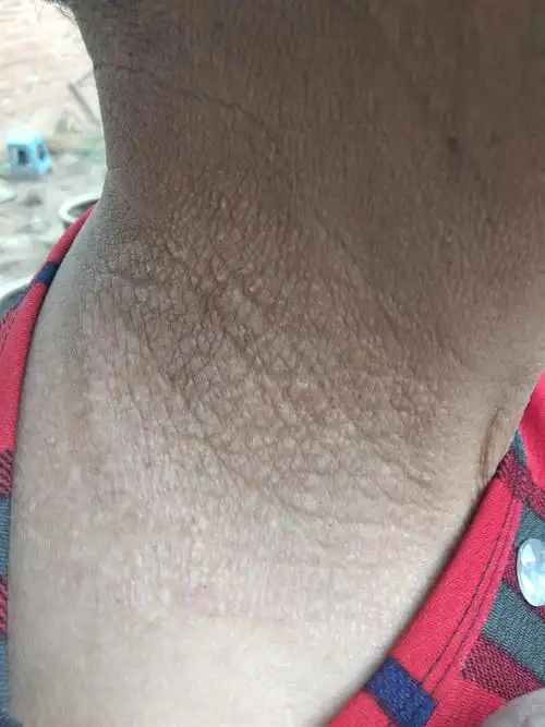 神经性皮炎 - 皮肤及性传播疾病讨论版 - 爱爱医医学论坛