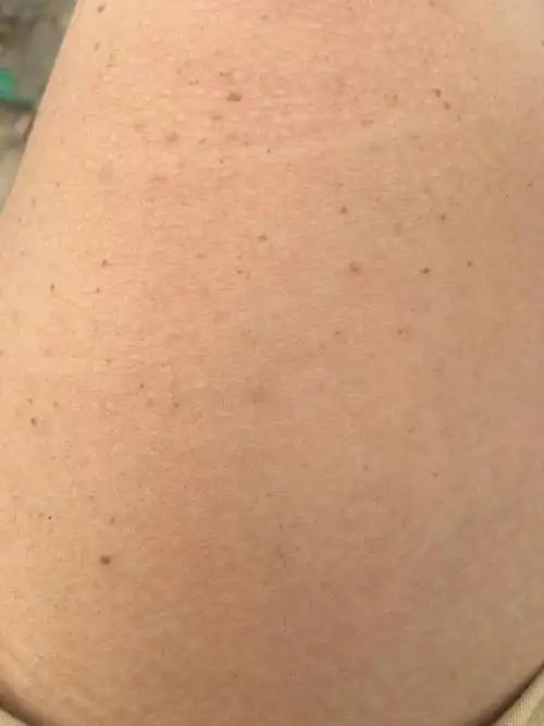 你好 请问下 胳膊和腿上都有这些小黑点是什么怎么去掉