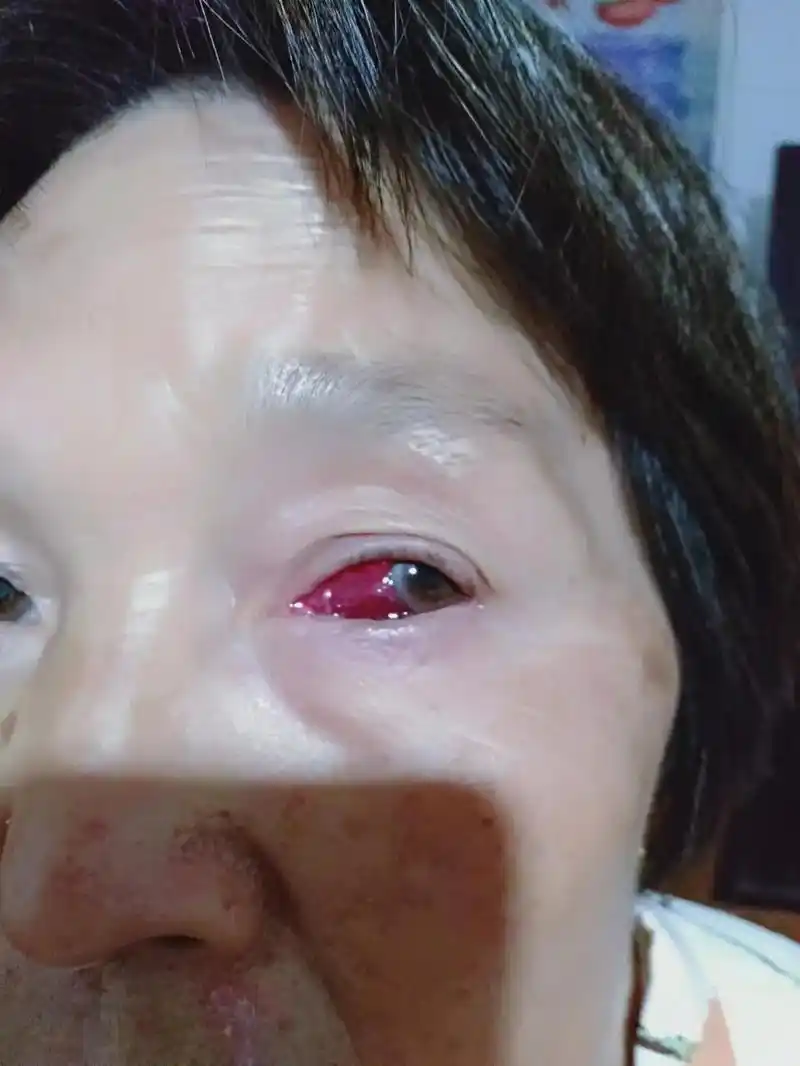 老妈昨天不小心摔了一跤,眼睛被扎破了,问她严不严重,她说没事 - 抖音