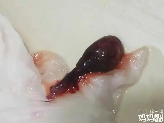 亲们 孕囊流出来了 终于不用受罪了 保佑 这段期间不要大出血就好了