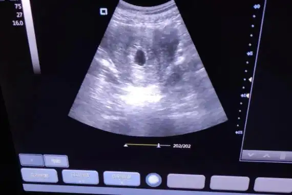 大量生男孩的胎囊数据分析,这2个看男孩最为关键! - 柚鼠知识