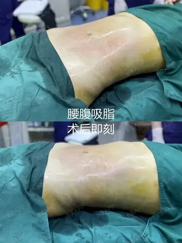 腰腹,妈妈臀吸脂术后第1天