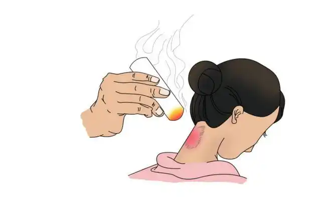 艾灸的好处有很多,但不适合人人都做,这几类人群最适合艾灸