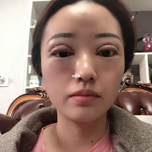 割双眼皮第三天,左眼肿的重,右眼没有那么严重,不过还是肿
