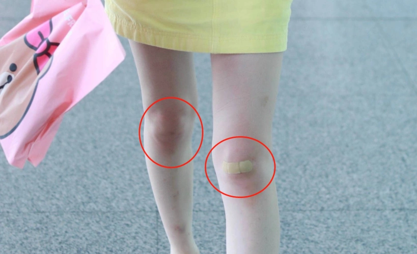 网友: 膝盖的伤是生日礼物吗