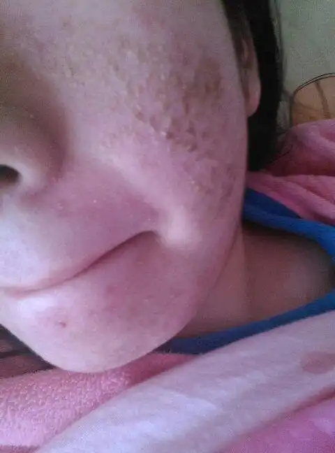 因为之前激素脸爆发出的激素后面部结痂,上网查说8至10天左右就掉痂