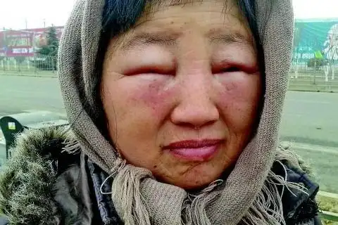 心理学解梦梦见眼睛肿了梦中的眼睛,这个梦境寓意着也是代表观察和