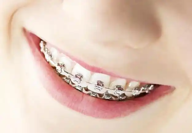 金属托槽牙齿矫正钢丝扎嘴磨嘴怎么办