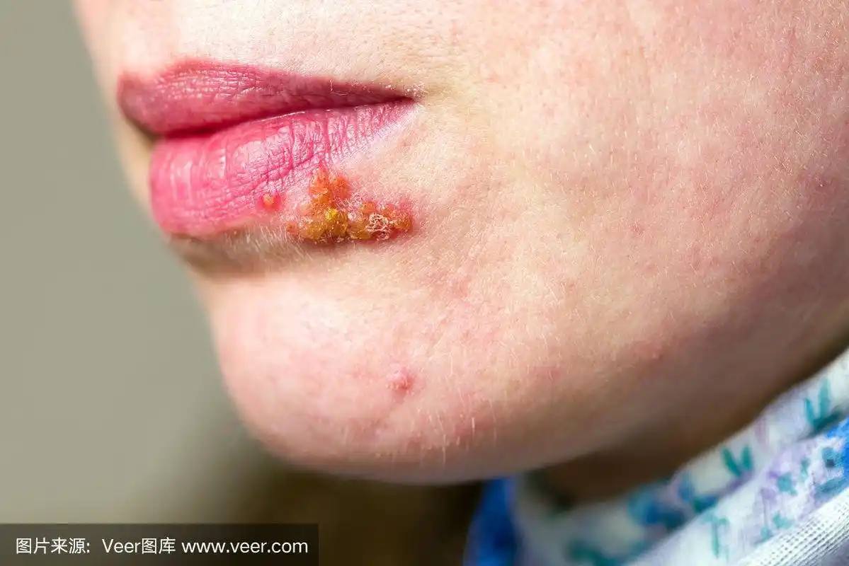 疱疹,嘴唇,水平画幅,疙瘩,痛苦