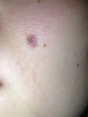 谁有人点过痣的,我这痣掉咖已经半个多月了,能恢复到皮肤一样的颜色嘛