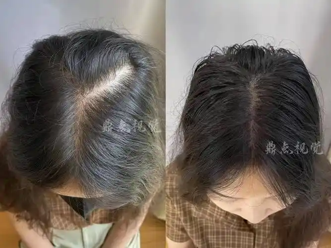 脱发4大预兆_头发_毛囊_头顶部