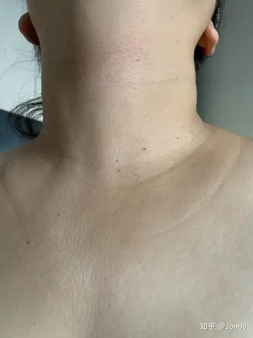 治疗丝疣的历程