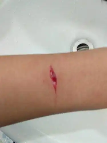 用刀把手皮肉划开怎样快速处理?