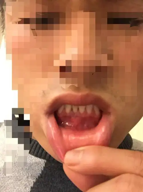 我的下牙床牙龈处长了包,挺硬的,但是不痛,请问这是怎么回事,有没有