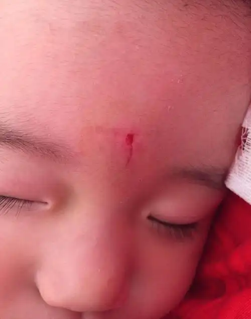 宝宝2岁额头磕破一道口子结疤了但是不小心蹭掉了壳子会不会留疤